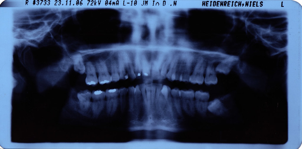 What happens if you don't get your wisdom teeth removed